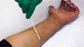 A new clinical trial at National Jewish Health uses lotion containing beneficial bacteria to fight the harmful bacteria on the skin of eczema patients. Researchers hope it will lead to a long-term solution for those suffering with the painful, itchy skin associated with the disease.